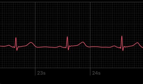 Atrial Sydney