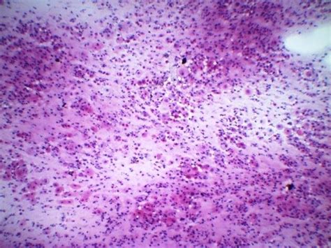 Atrophic Pattern Predominantly Parabasal Cells