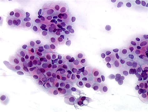 Atrophic Smear Pattern