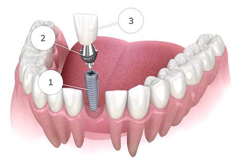 Attachment of Artificial Tooth