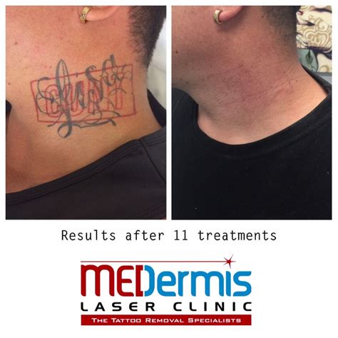 PicoSure Laser Removal Of A Recalcitrant Tattoo