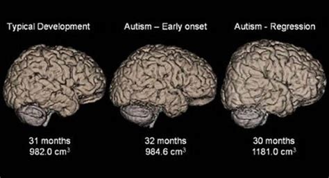 Autism Brain