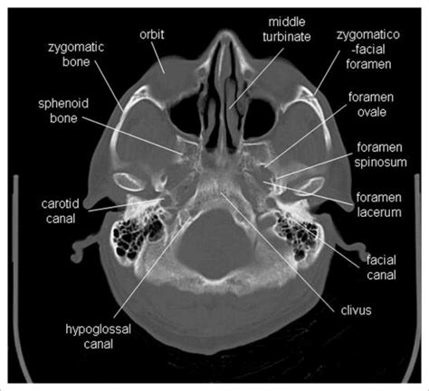 Orbital apex anatomy CT. Axial and coronal CT slices
