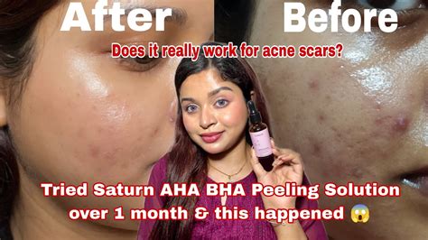 BHA untuk Bekas Jerawat