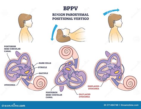 BPPV & Vertigo: Causes, Relief, & Recovery