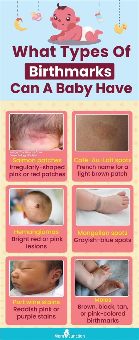 Baby Birthmarks: Causes, Types & Treatment