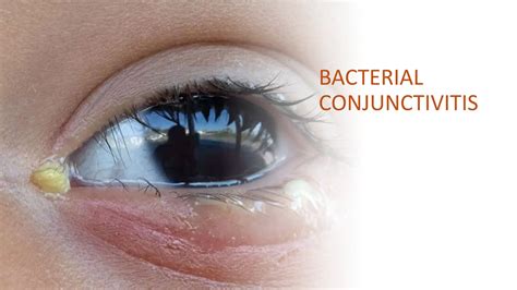 Bacterial Conjunctivitis: The Main Culprit