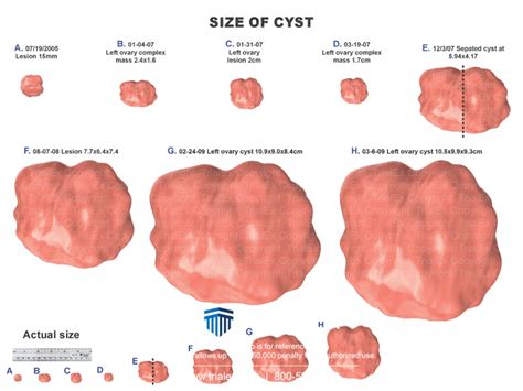 Bakers Cyst Size Chart