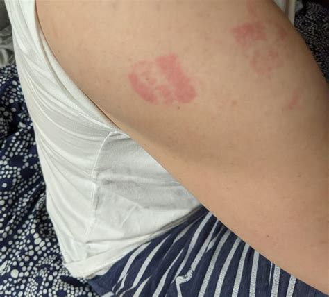 The Pain of Fashion: When Leftover Red Marks from Band-aids Sully Your Style