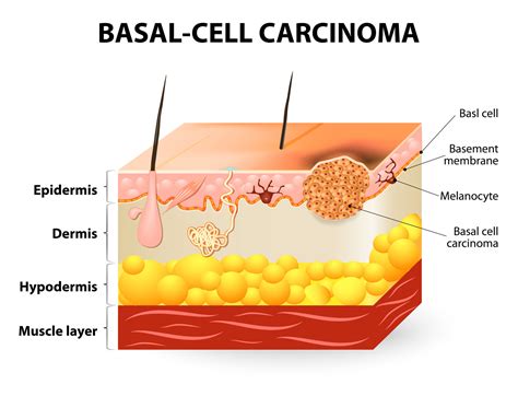 Basal Cell Skin