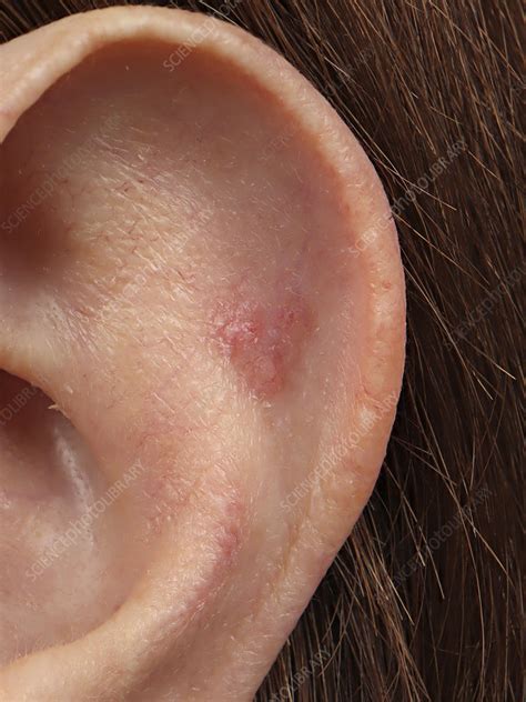 Cancer Ear