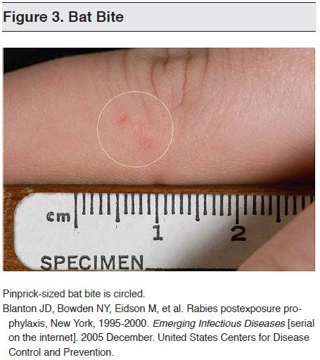 Unveiling the Mysterious Mark of The Nocturnal Predator: The Intriguing world of Bat Bite Marks on Skin
