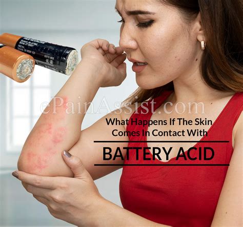 Acid Burns: The Terrifying Reality of Battery Acid Contact with Skin