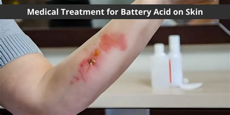 Skin Sizzle: Shocking Battery Acid Burns Captured in Pictures - A Spine-Chilling Visual Journey Through the Dangers of Battery Acid on Skin