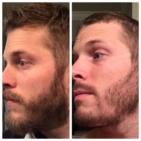 Beard Before And After Biotin
