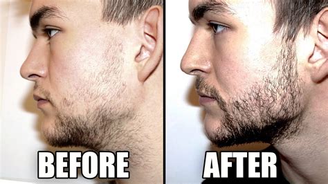 Beard Growth Kit Before And After