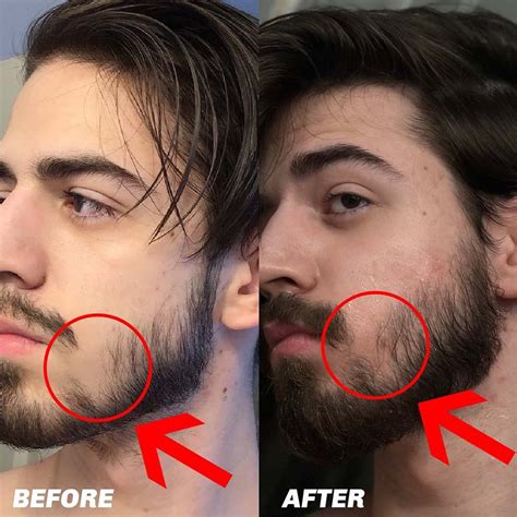 Beard Growth Treatment