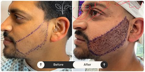 Beard Hair Transplant