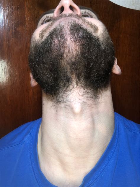 Beard Patch Under Chin