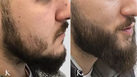 Beard Transplant Adelaide