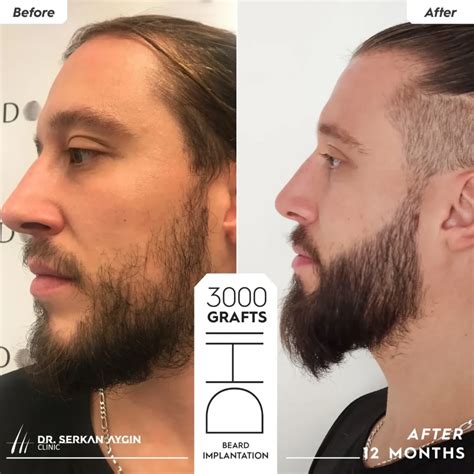 Beard Transplant Cost