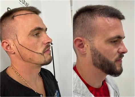 Beard Transplant Melbourne