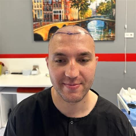 Beard transplantation bleeding