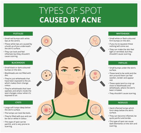 Beat Acne: Causes & Effective Treatments