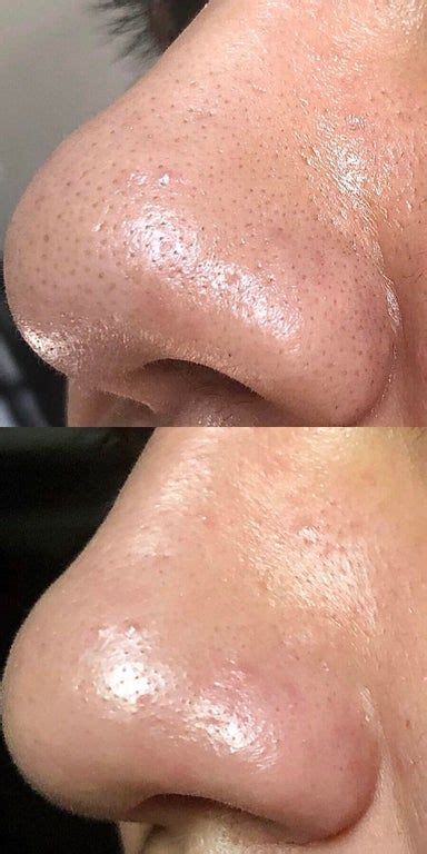 Transform Your Skin with a Stunning Before and After Grits Experience: Unveiling the Secret to Radiant Beauty