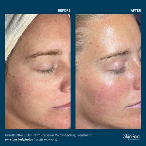 Transform Your Skin: The Incredible Before and After Effects of the Revolutionary Skin Pen Treatment