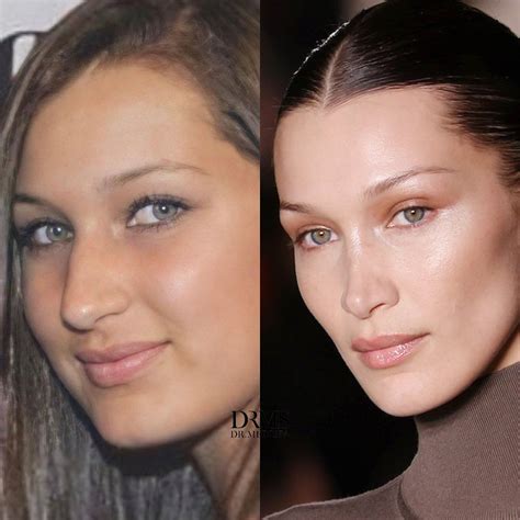 Bella Hadid Nose Job