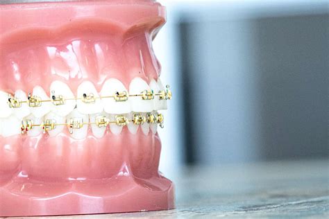 Beneficial Facts About Gold Braces