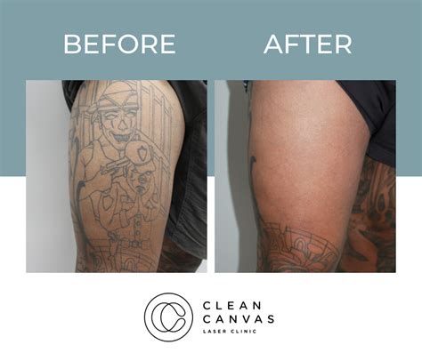 Laser Tattoo Removal Sydney The 1 Rated Tattoo Removal