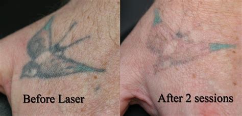 Laser Tattoo Removal experts with 15 years experience