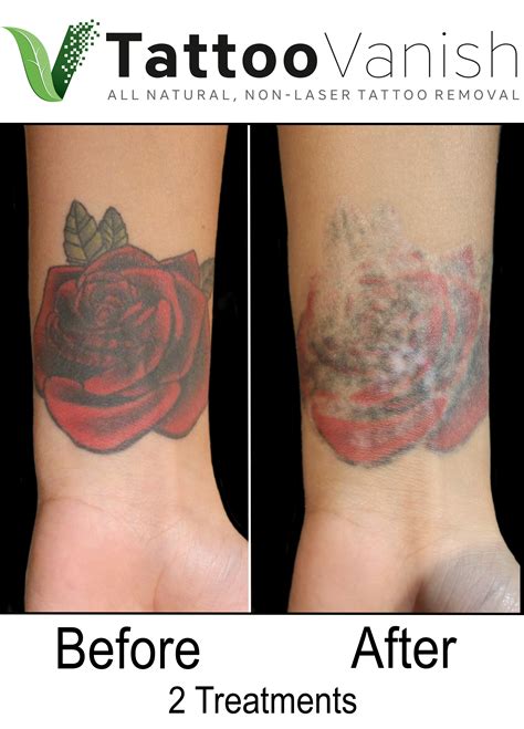 Best Tattoo Removal in Miami AllNatural & NonLaser