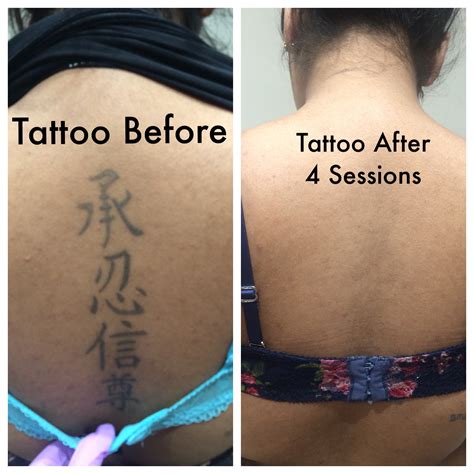 Invisible Ink Tattoo Removal PicoWay Laser Treatment