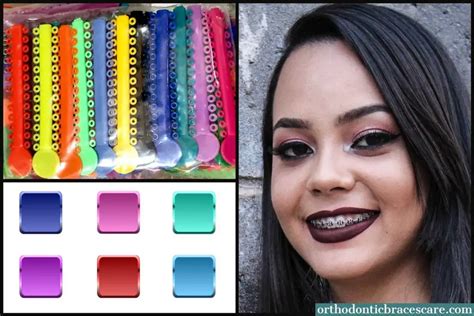 Radiant Smiles: Unveiling the Top Color Braces for Dazzling Results on Light Skin