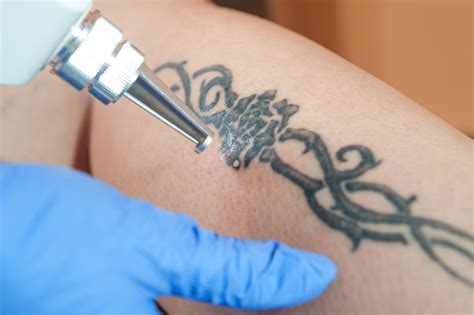 Best Tattoo Removal Laser