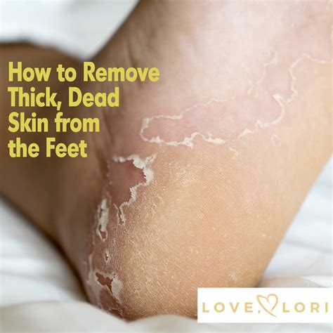 Transform Your Tired Tootsies with the Best Way to Eliminate Dead Skin from Feet: Expert Tips for Soft and Supple Soles!