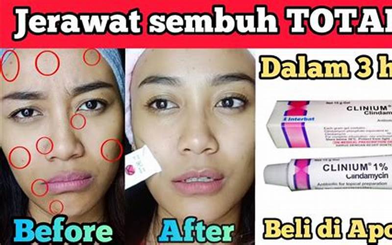 Betamethasone, Obat Ampuh Untuk Jerawat