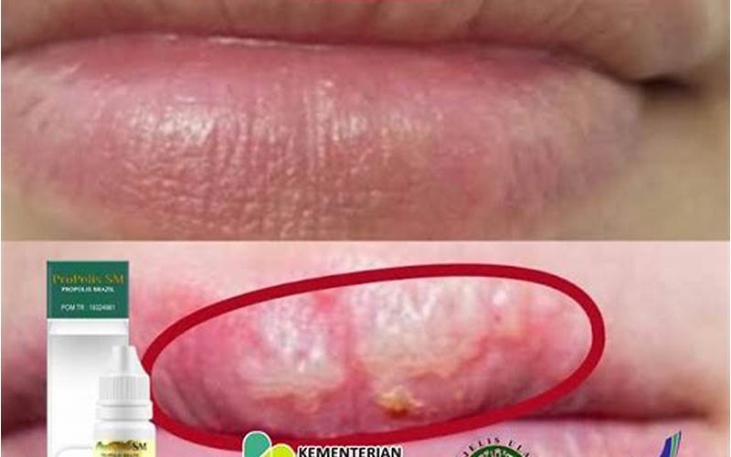 Bibir Ada Bintik Seperti Jerawat, Ini Solusinya!