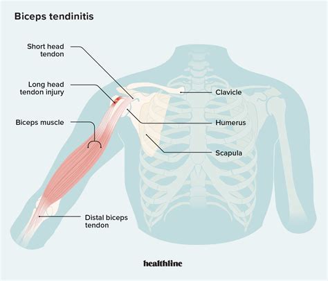 Bicep Tendonitis From Pull Ups