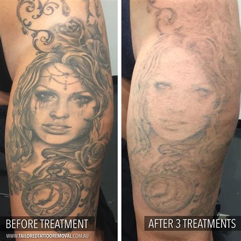 Pin on Tattoo Removal Before and After