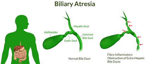 Biliary Atresia: Early Signs & Treatment Options