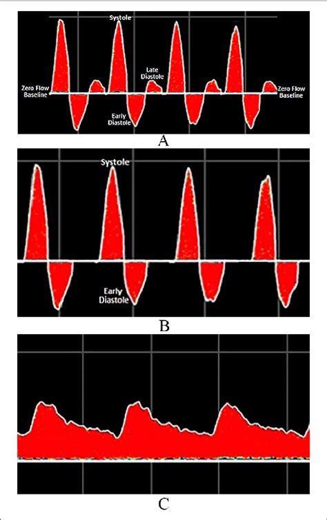 Biphasic Signal Pattern