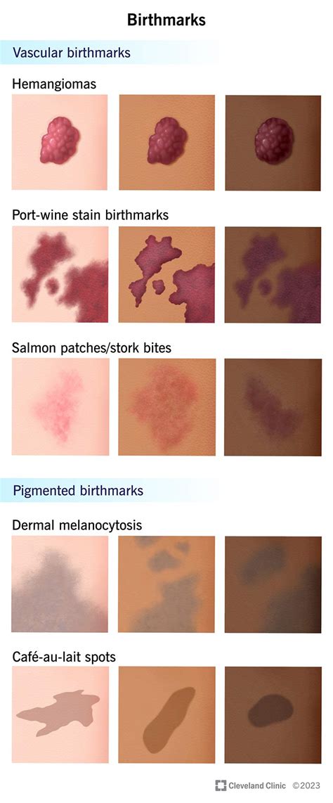 Birthmark Removal: Types, Causes & Solutions.