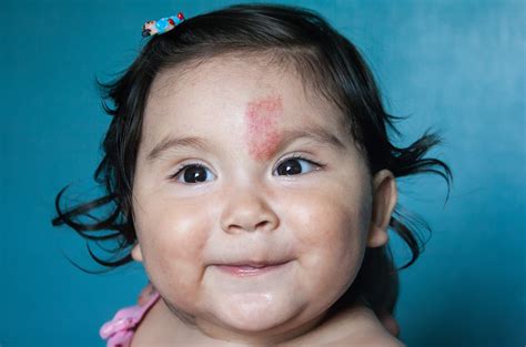 Baby Birthmarks Types and Causes Pampers