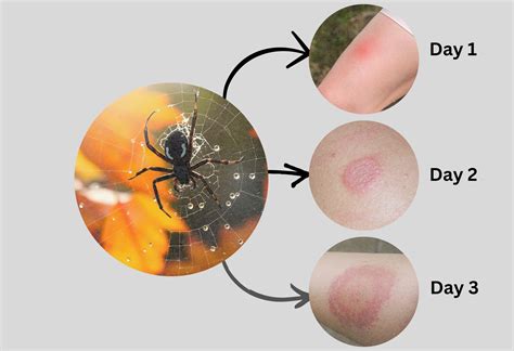 Bitten By A Spider