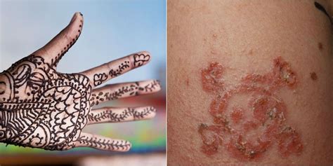 Doctors Caution Against Black Henna Tattoos After 10Year