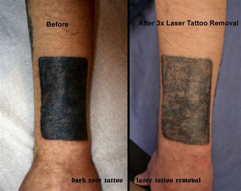 Laser Tattoo Removal Results on Abdomen